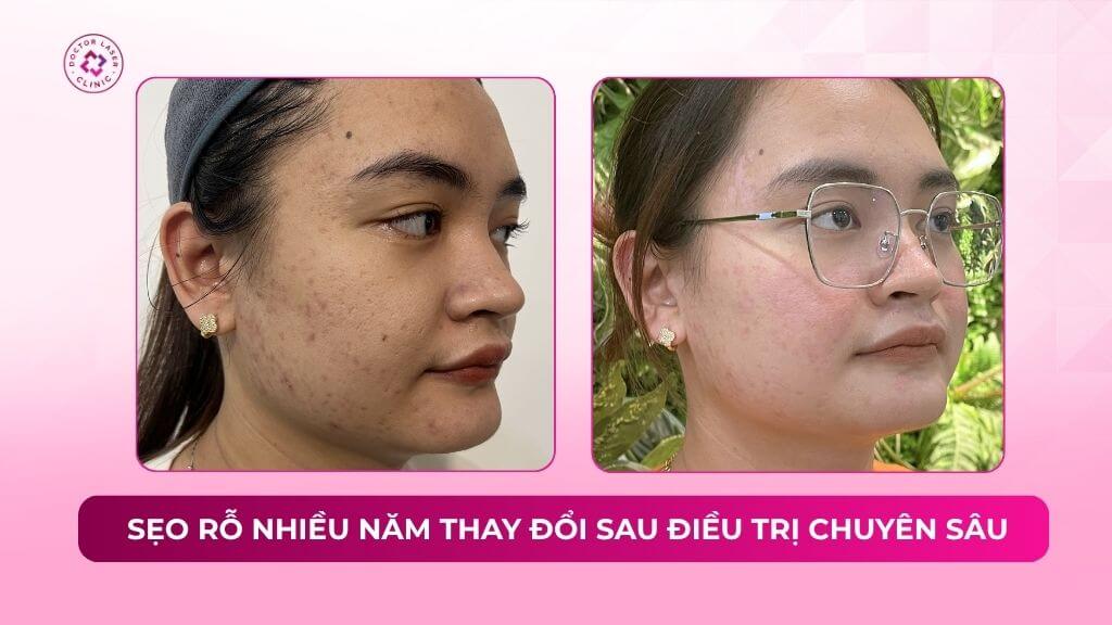 sẹo rỗ nhiều năm thay đổi sau điều trị chuyên sâu