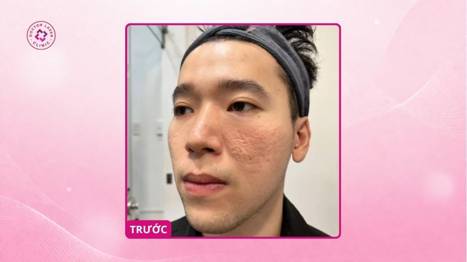 sẹo rỗ trước điều trị laser co2 fractional doctor laser