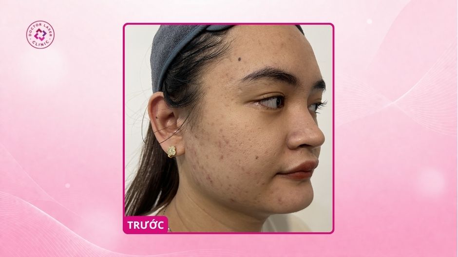 sẹo rỗ trước điều trị nặn mụn sai cách