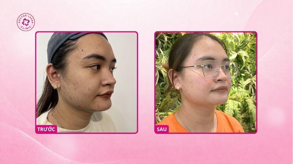 sẹo rỗ trước sau điều trị laser co2 fractional