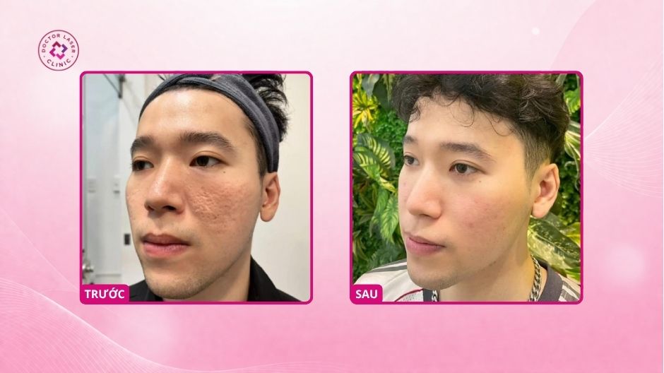 sẹo rỗ trước sau laser co2 fractional doctor laser tphcm