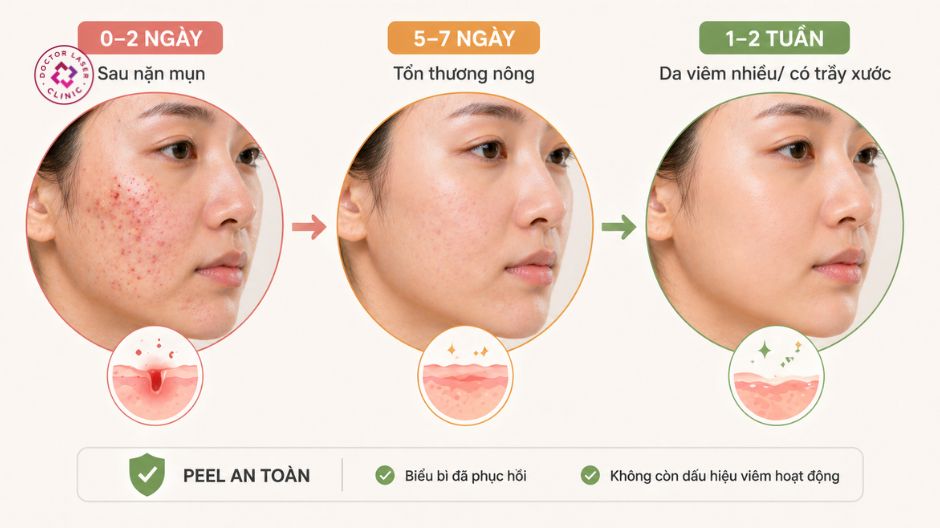 thời điểm peel da an toàn sau mụn
