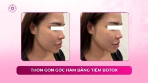 thon gọn góc hàm bằng tiêm botox