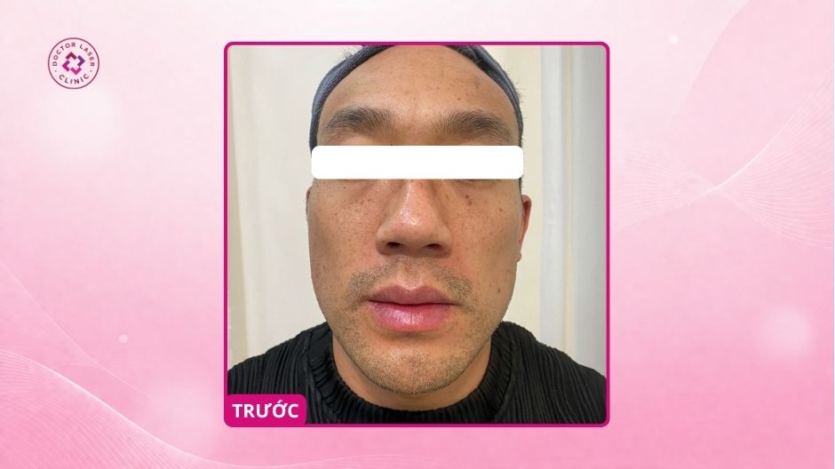 tình trạng nám da đốm nâu trước laser pico