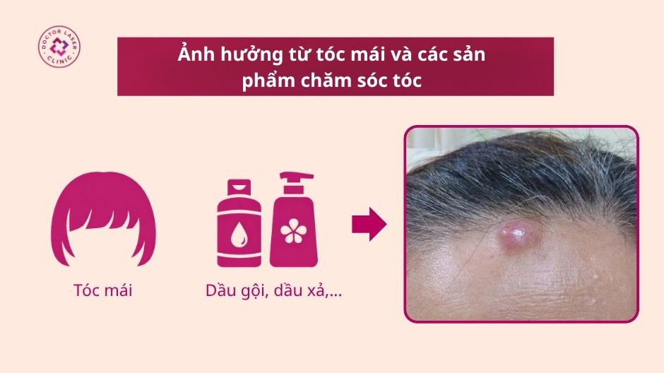 tóc mái và sản phẩm chăm sóc tóc gây mụn bọc trán