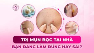 trị mụn bọc tại nhà