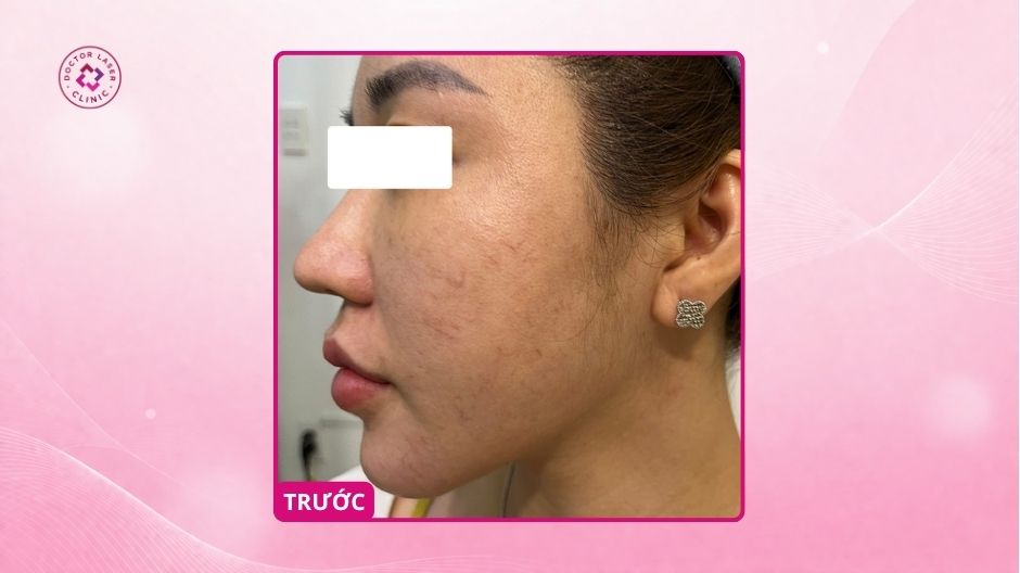 trước điều trị lộ mao mạch da đỏ mặt