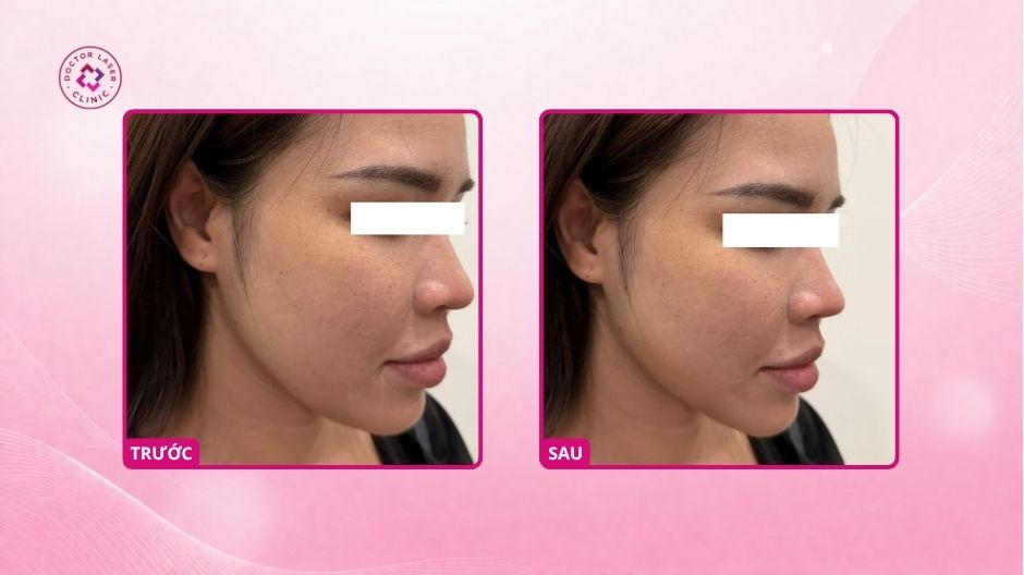 trước sau tiêm botox gọn hàm doctor laser