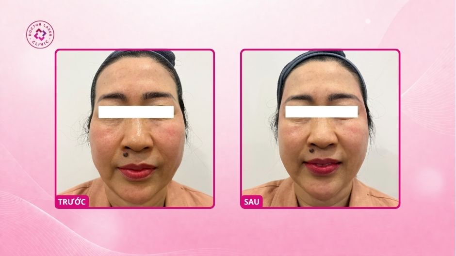 trước sau tiêm filler thái dương tại doctor laser
