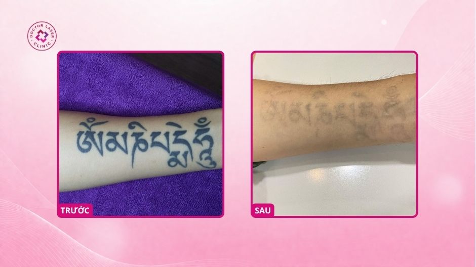 trước sau xoá hình xăm cánh tay doctor laser