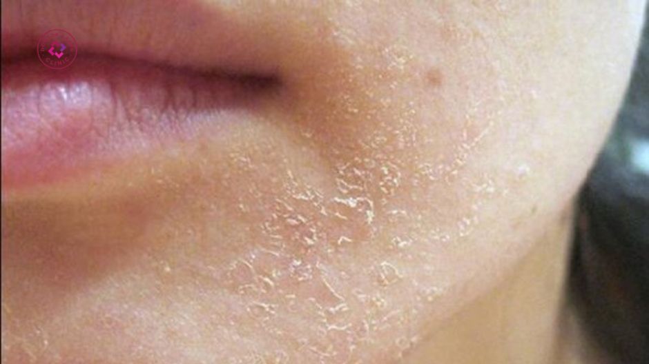 ưu điểm peel da trị mụn