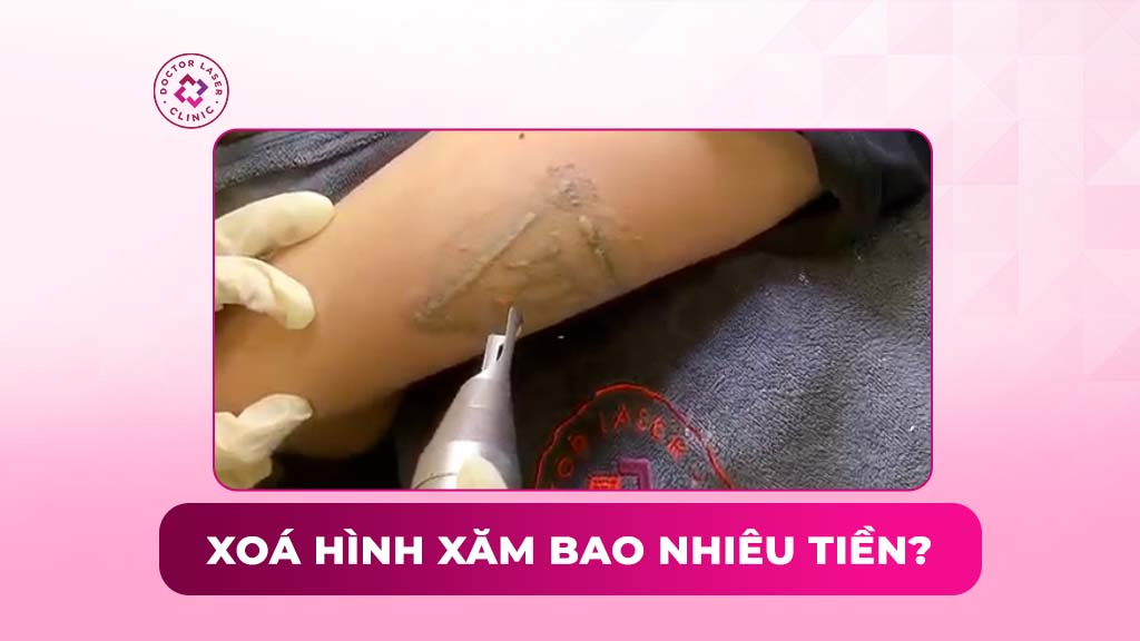 xoá hình xăm bao nhiêu tiền