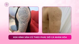 xoá hình xăm cũ theo phác đồ cá nhân hoá
