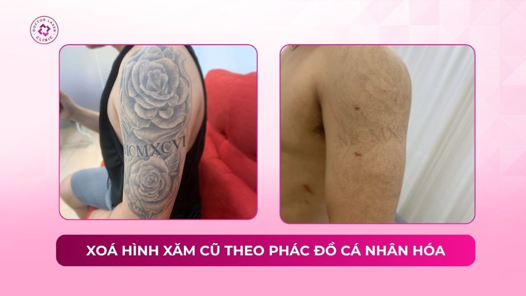 xoá hình xăm cũ theo phác đồ cá nhân hoá