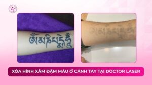 xoá hình xăm đậm màu ở cánh tay tại doctor laser