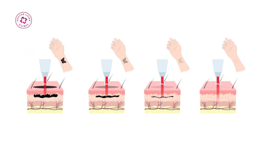 xoá xăm bao nhiêu buổi để đạt hiệu quả tối ưu