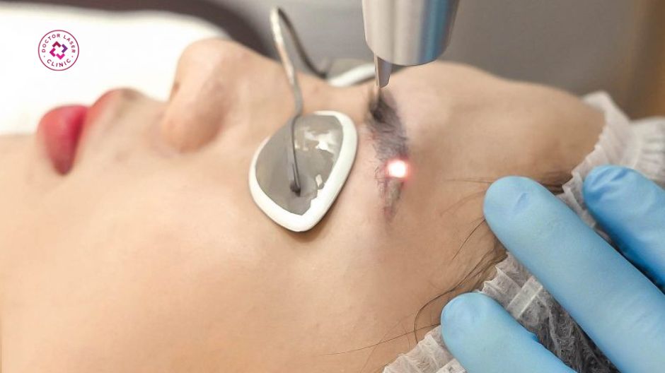 xoá xăm chân mày bằng laser có hết không