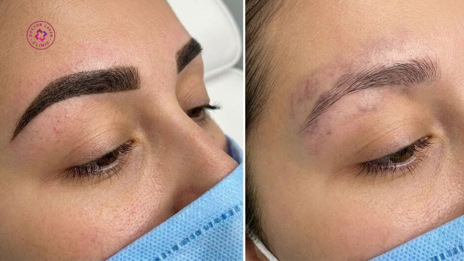 xoá xăm chân mày bằng laser đa bước sóng