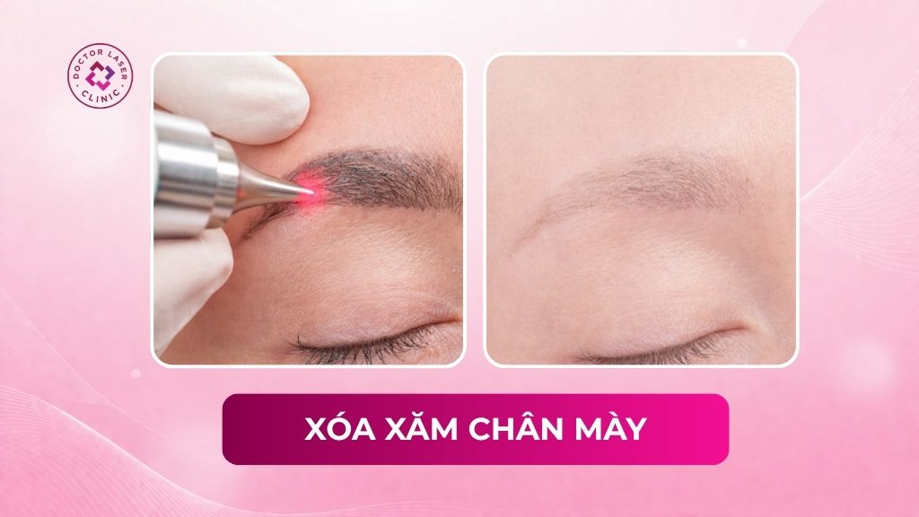 Xóa xăm chân mày (lông mày) có hết không? Phương pháp thực hiện