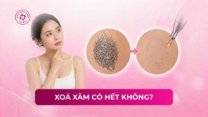 xoá xăm có hết không
