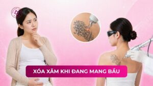 xoá xăm đi đang mang bầu