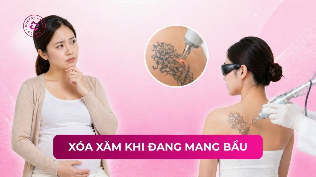 xoá xăm đi đang mang bầu