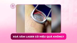 xoá xăm laser có hiệu quả không