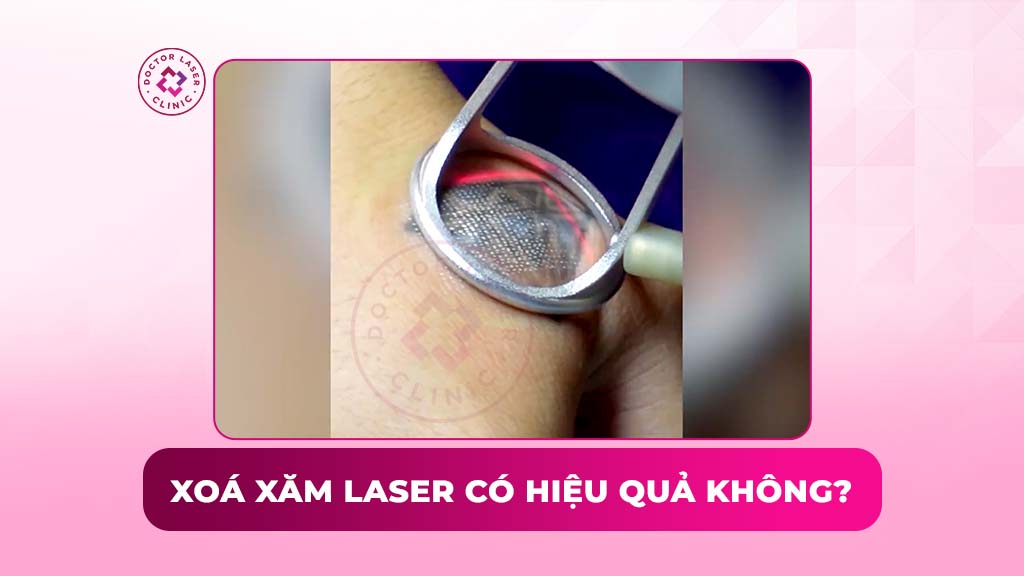 Xóa xăm laser có hiệu quả không? Ưu nhược điểm và rủi ro