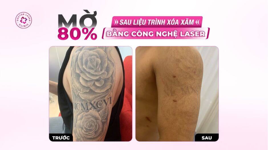xoá xăm trước sau bằng laser pico co2