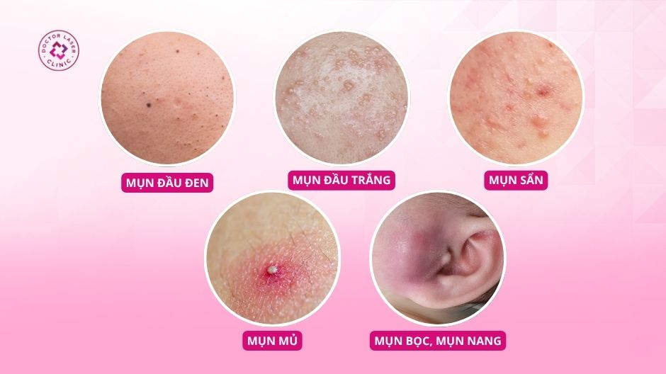 các loại mụn ở tai thường gặp