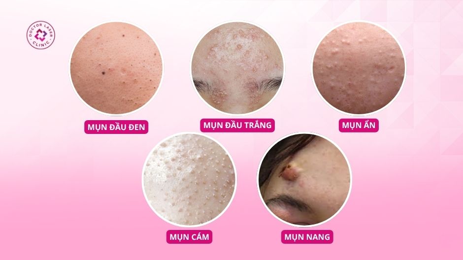 các loại mụn ở trán thường gặp