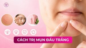 cách trị mụn đầu trắng