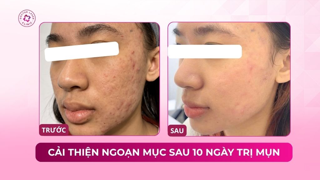 cải thiện ngoạn mục sau 10 ngày trị mụn