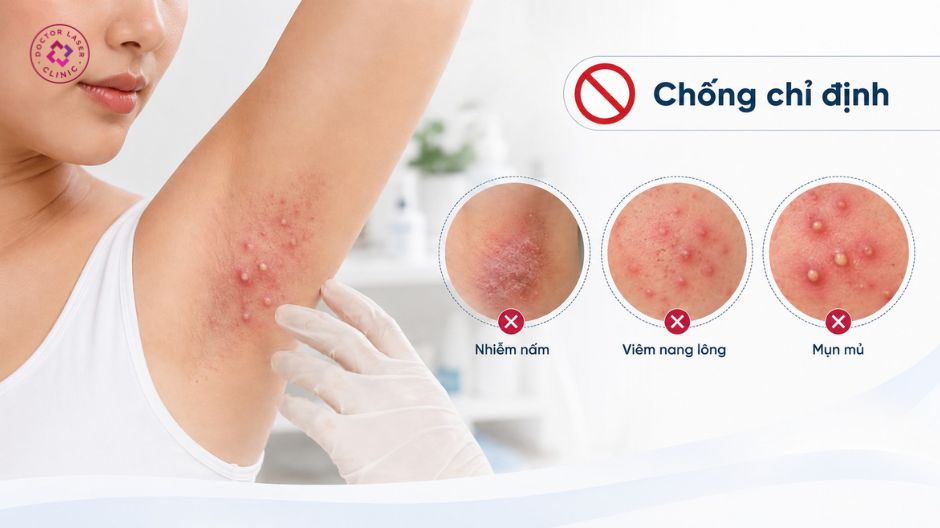 chống chỉ định không peel nách