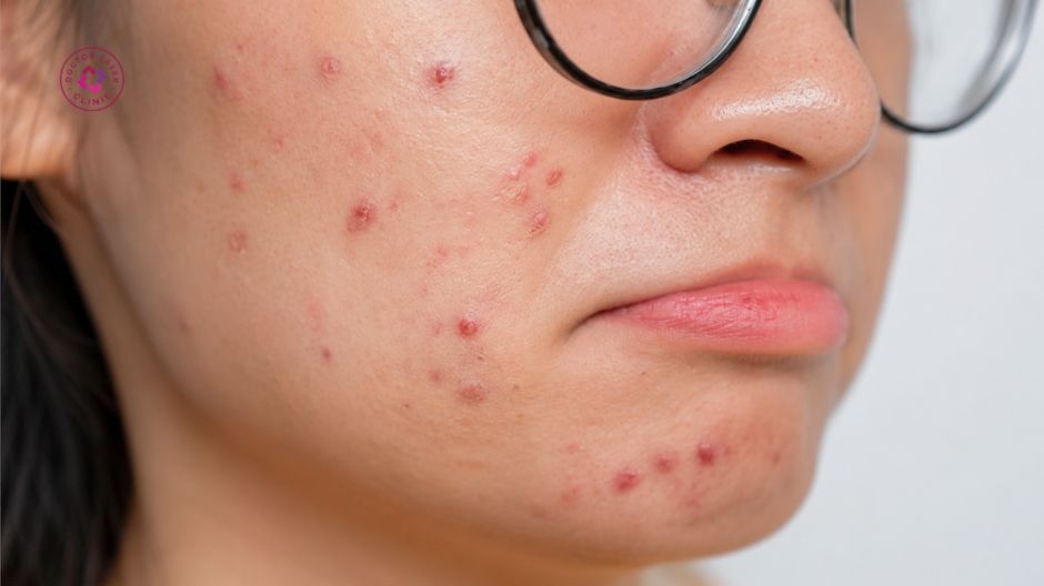 di truyền gây mụn ở má