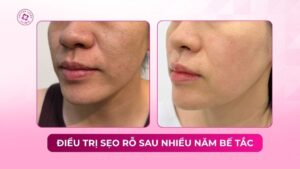điều trị sẹo rỗ sau nhiều năm bế tắc
