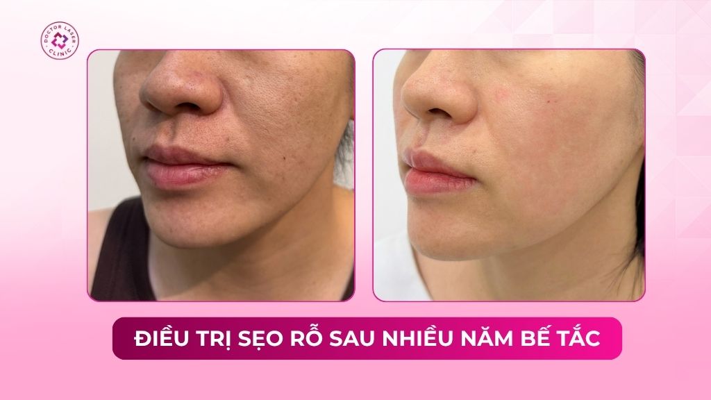 điều trị sẹo rỗ sau nhiều năm bế tắc