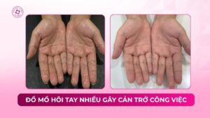đổ mồ hôi tay gây cản trở công việc