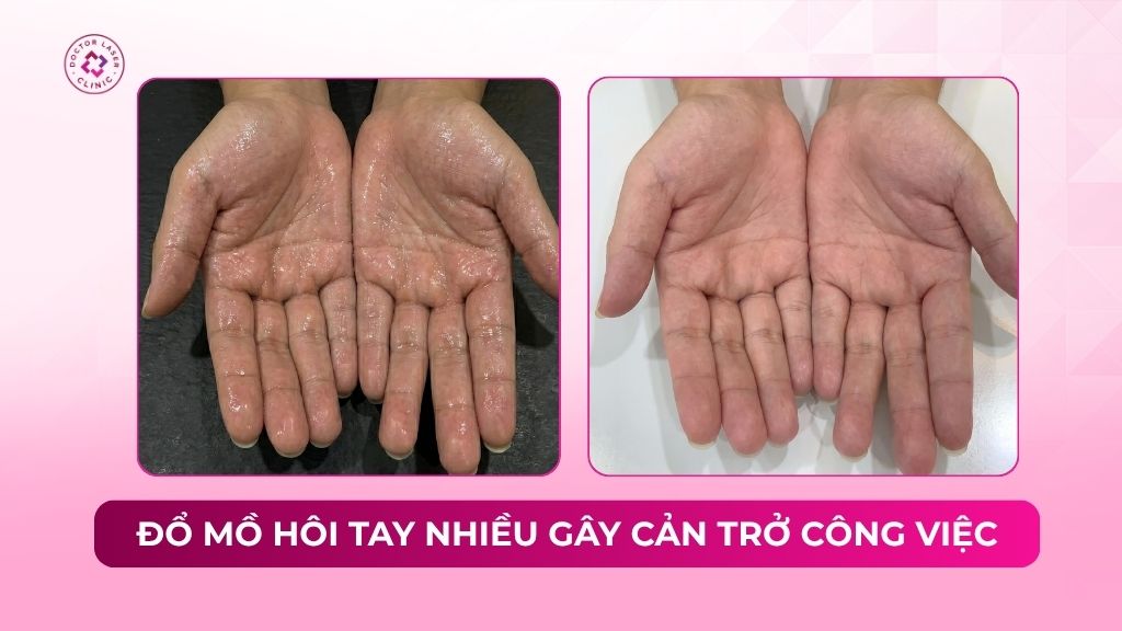 đổ mồ hôi tay gây cản trở công việc