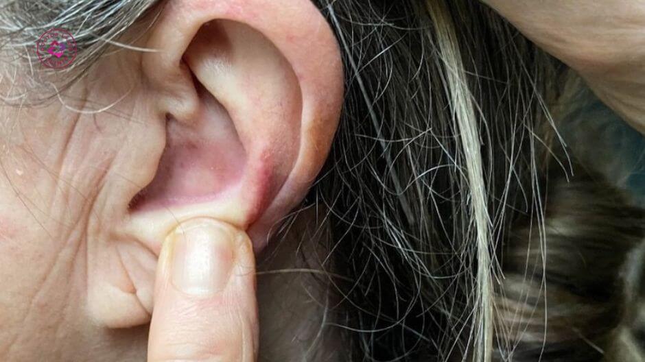 dùng tay chưa sạch chạm gãi nặn mụn ở tai