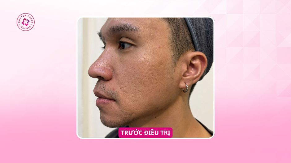 hình ảnh sẹo rỗ trước điều trị anh t tại doctor laser