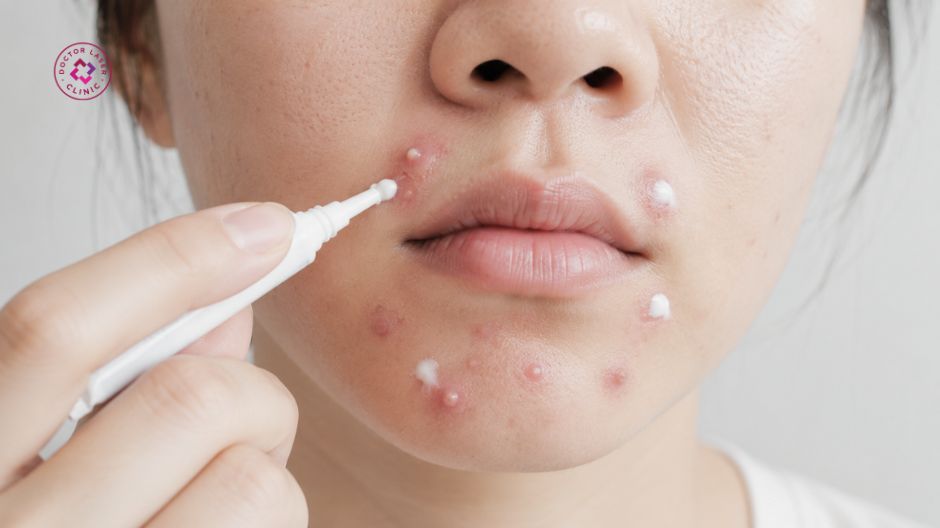 hoạt chất bôi thoa trị mụn quanh miệng
