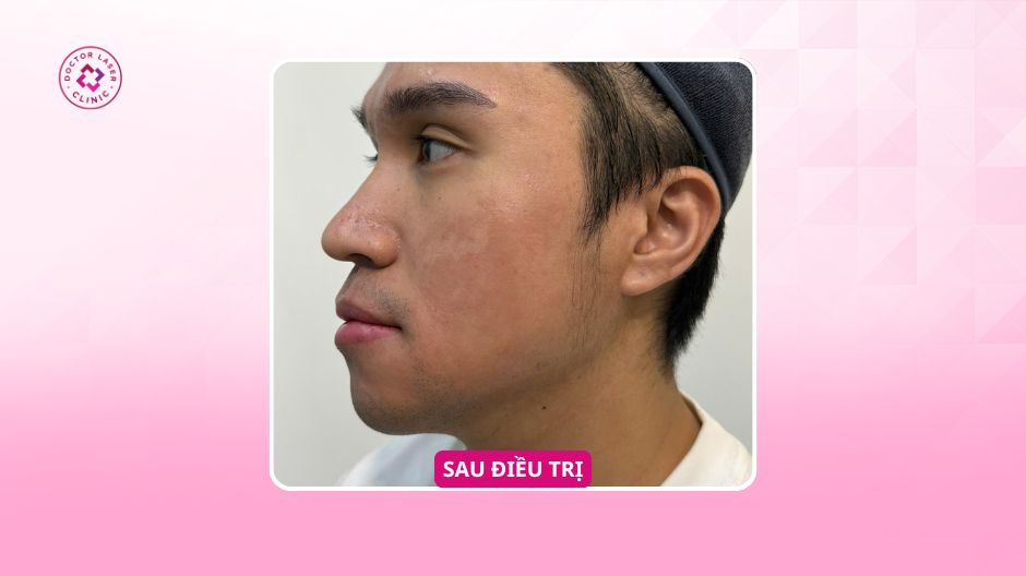 kết quả điều trị sẹo rỗ anh t doctor laser