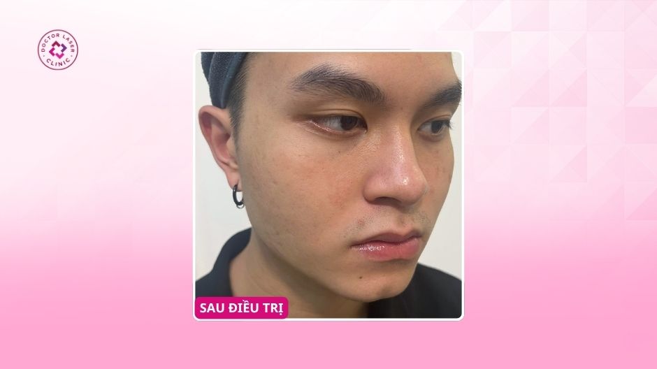 kết quả điều trị sẹo tuổi dậy thì