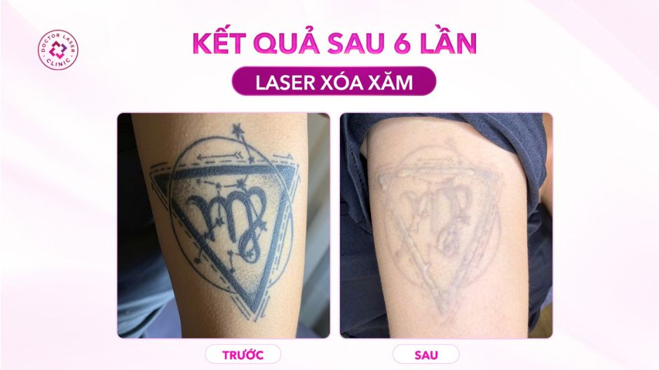 kết quả sau 6 làn laser xoá xăm hình xăm mờ rõ