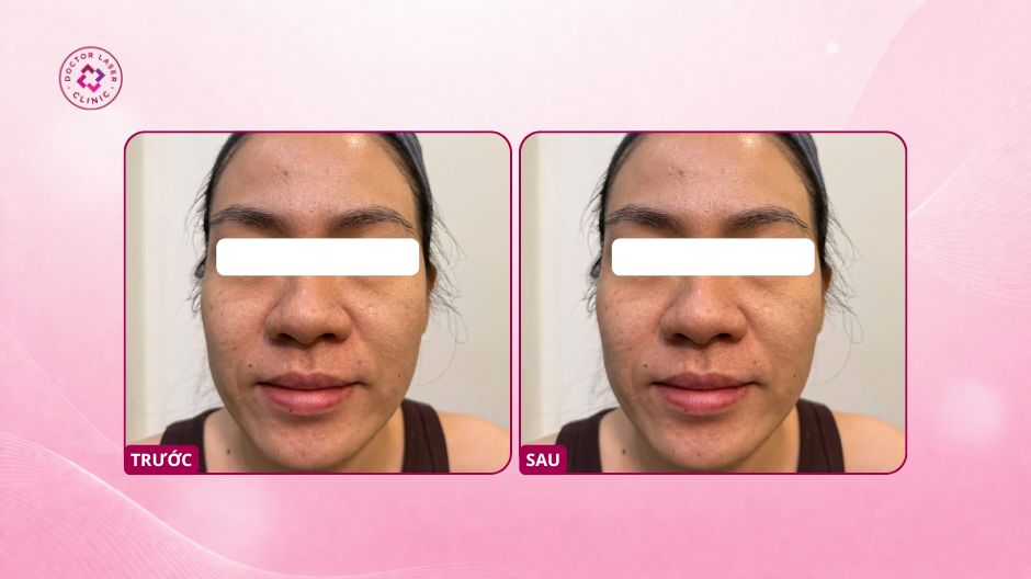 kết quả trước sau điều trị sẹo rỗ chị t bình thạnh