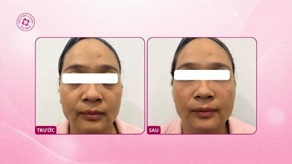 kết quả trước và sau tiêm ha vùng mắt cải thiện thâm quầng