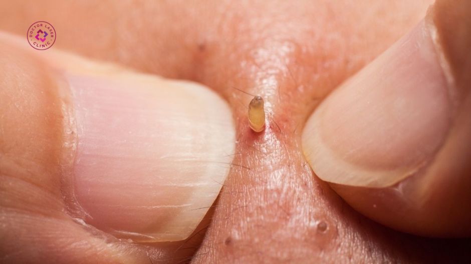 loại mụn được nặn
