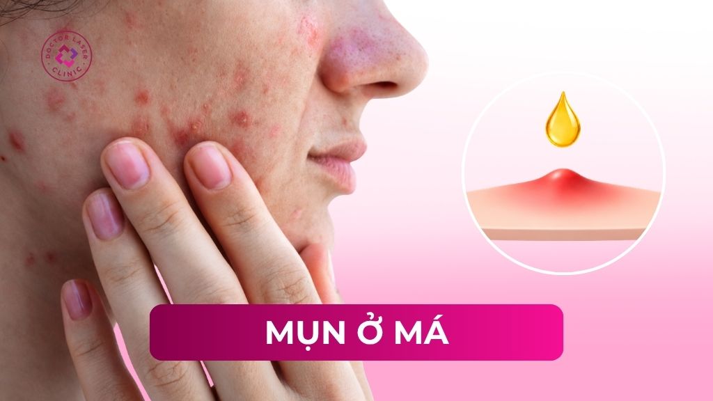 Nổi mụn ở má: Nguyên nhân, phân loại và phương pháp điều trị