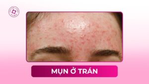 mọc mụn ở trán